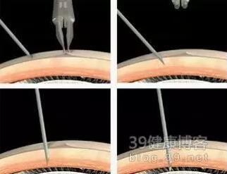 玻璃體腔注射的步驟和安全技術要點
